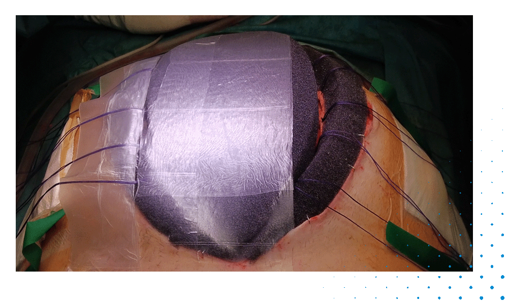 Case Report Abdomen_Videopreview_Adhesive Dressing