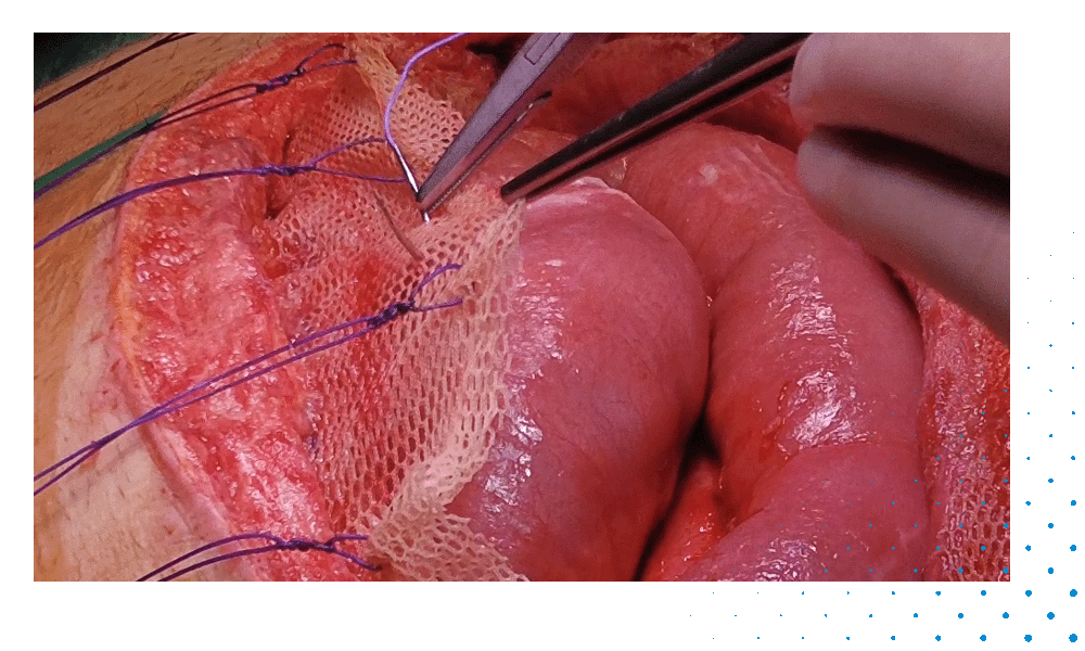 Case Report Abdomen_Videopreview_Traction Sutures