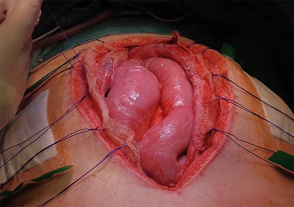 Case Reports Abdomen_Brilon