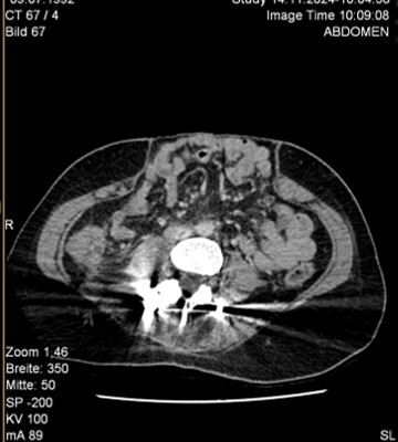 CT_Abdomen_Herne_2