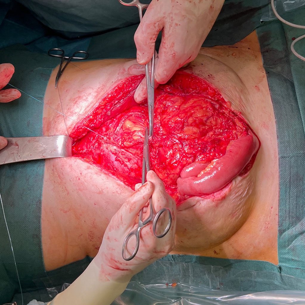 Closure of the posterior fascia sheet