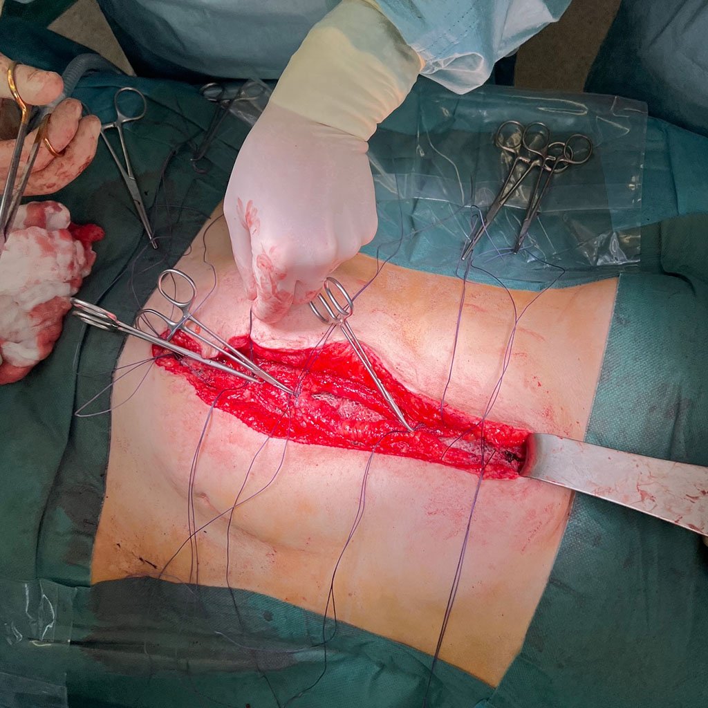 Clousure of the anterior fascia sheet