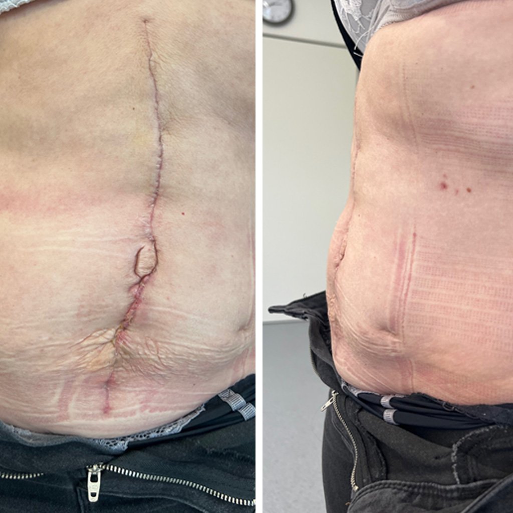 Postoperative cosmetic result