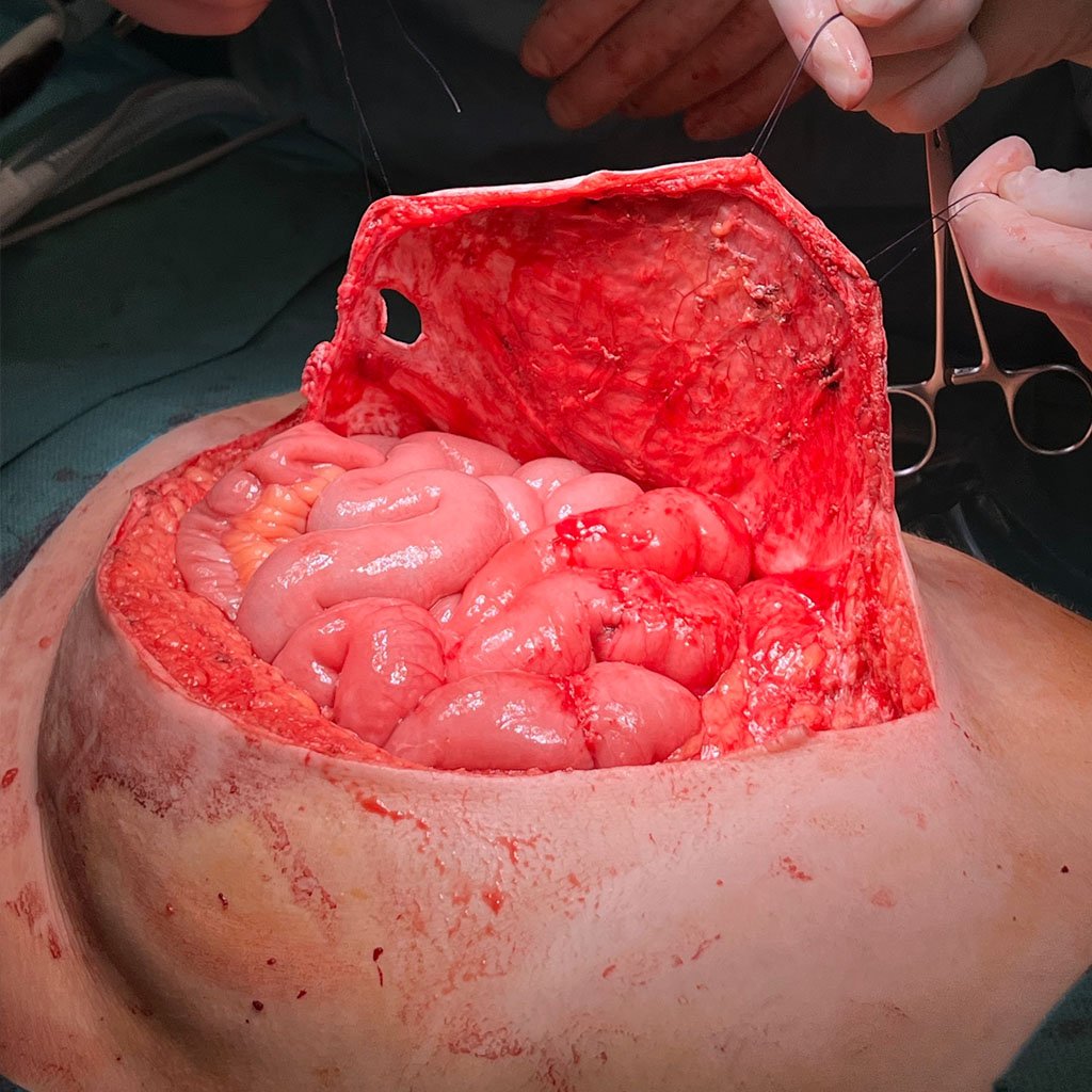 Surgical removal of the skin graft
