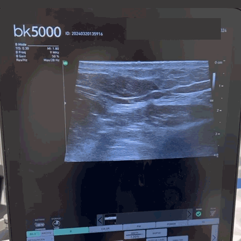 Ultrasound