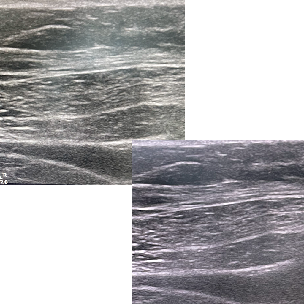 Lateral hernia_0002_Botox
