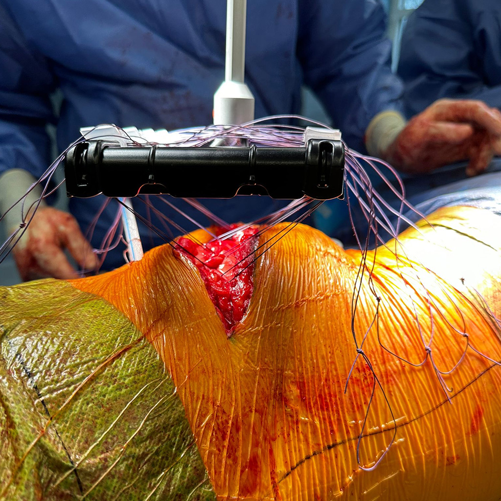 Lateral hernia_Hero image