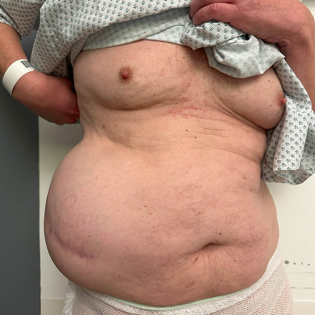 Lateral hernia__0000_Standing