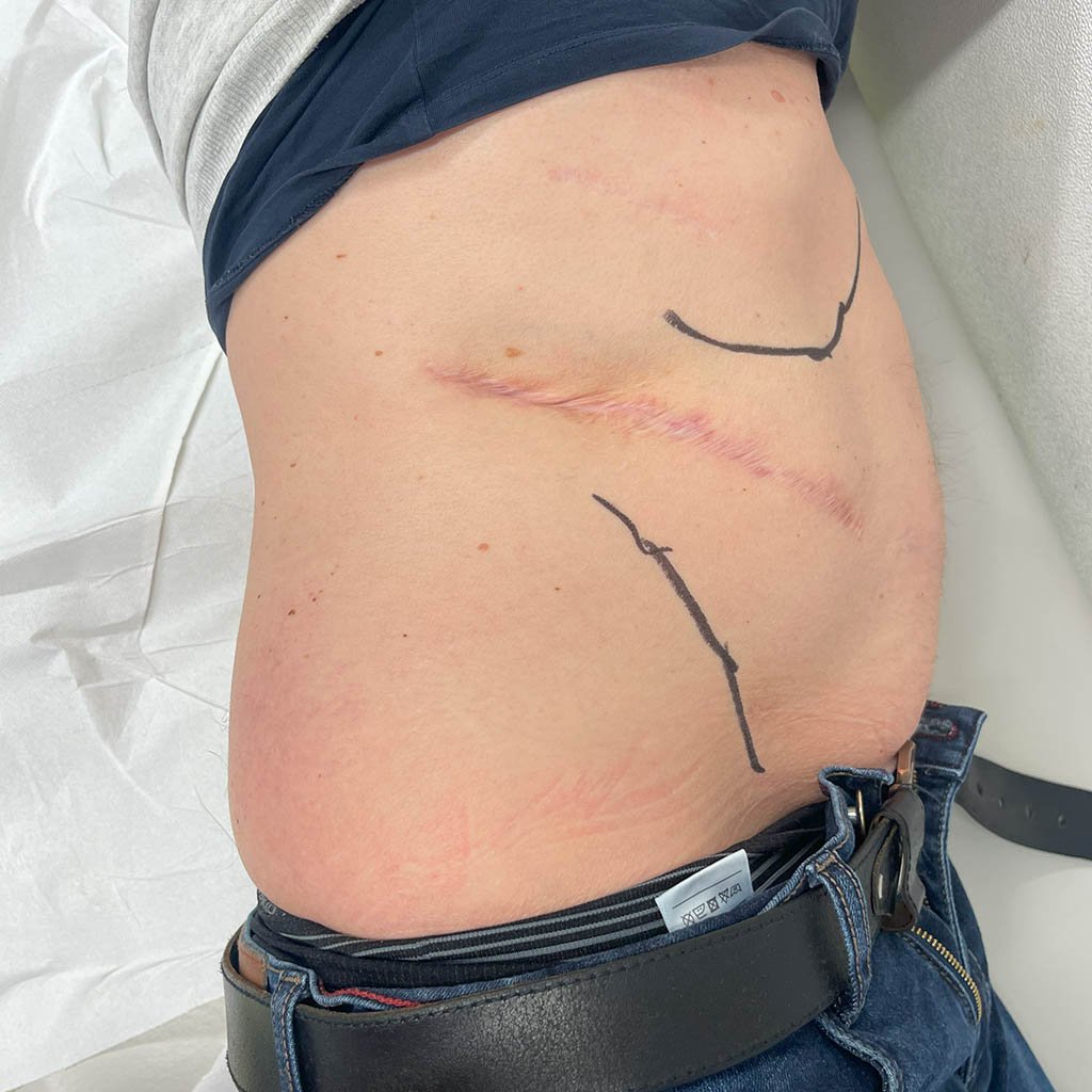 Lateral hernia__0001_Lying
