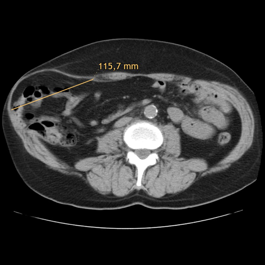 Lateral hernia__0002_CT Scan