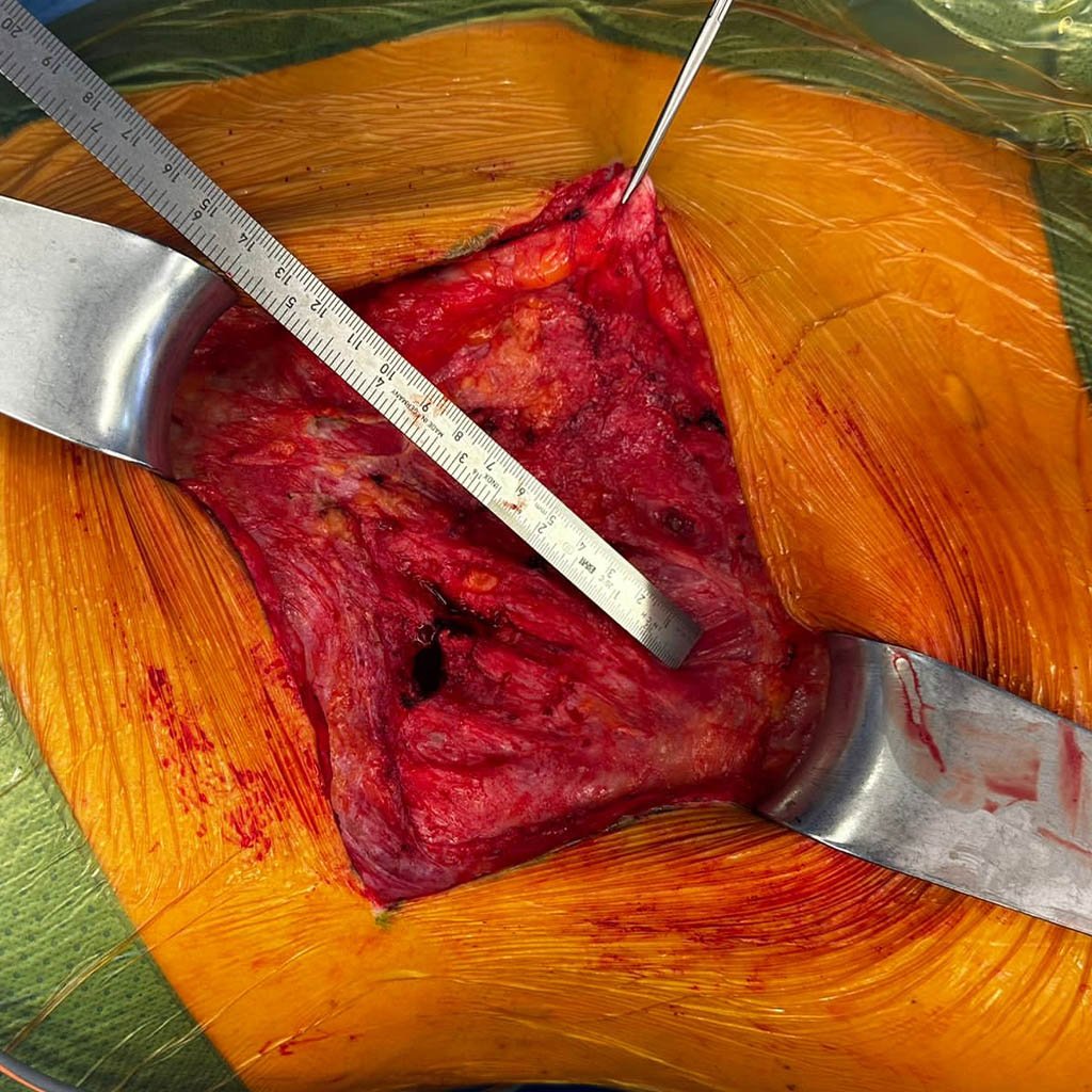 Lateral hernia__0005_Width