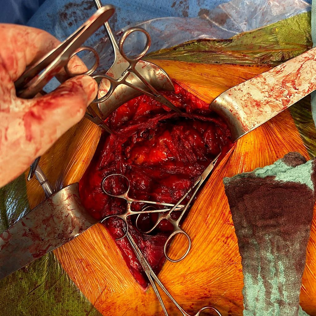 Lateral hernia__0006_Hernia sac