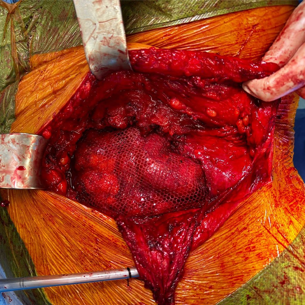 Lateral hernia__0007_Mesh