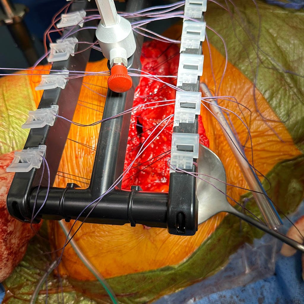 Lateral hernia__0008_Attaching system