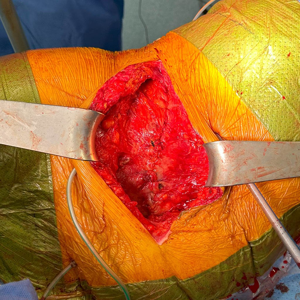 Lateral hernia__0010_Closure