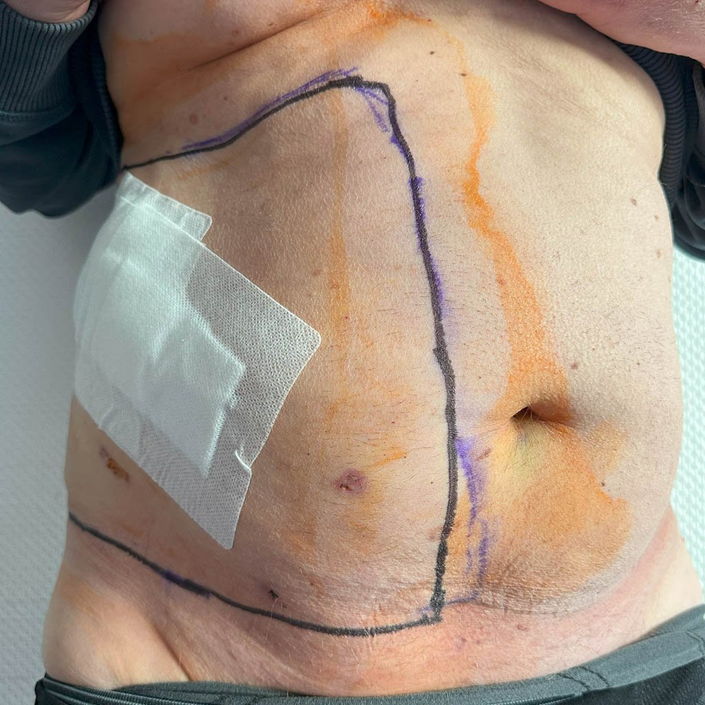 Lateral hernia__0011_No ICU