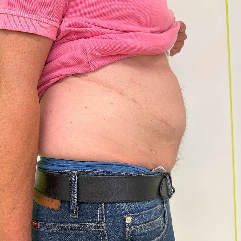 Lateral hernia__0013_Result_Post OP_2b