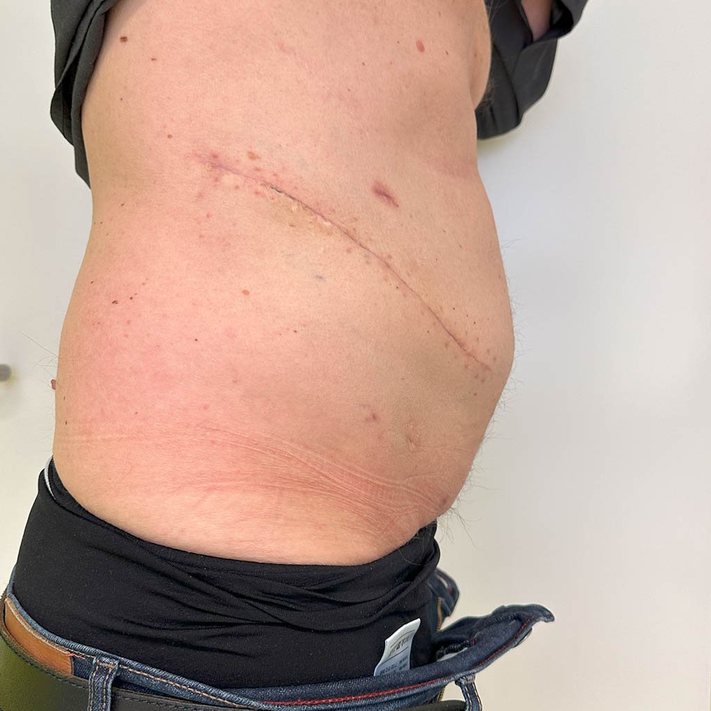 Lateral hernia__0014_Result_Post OP_1a