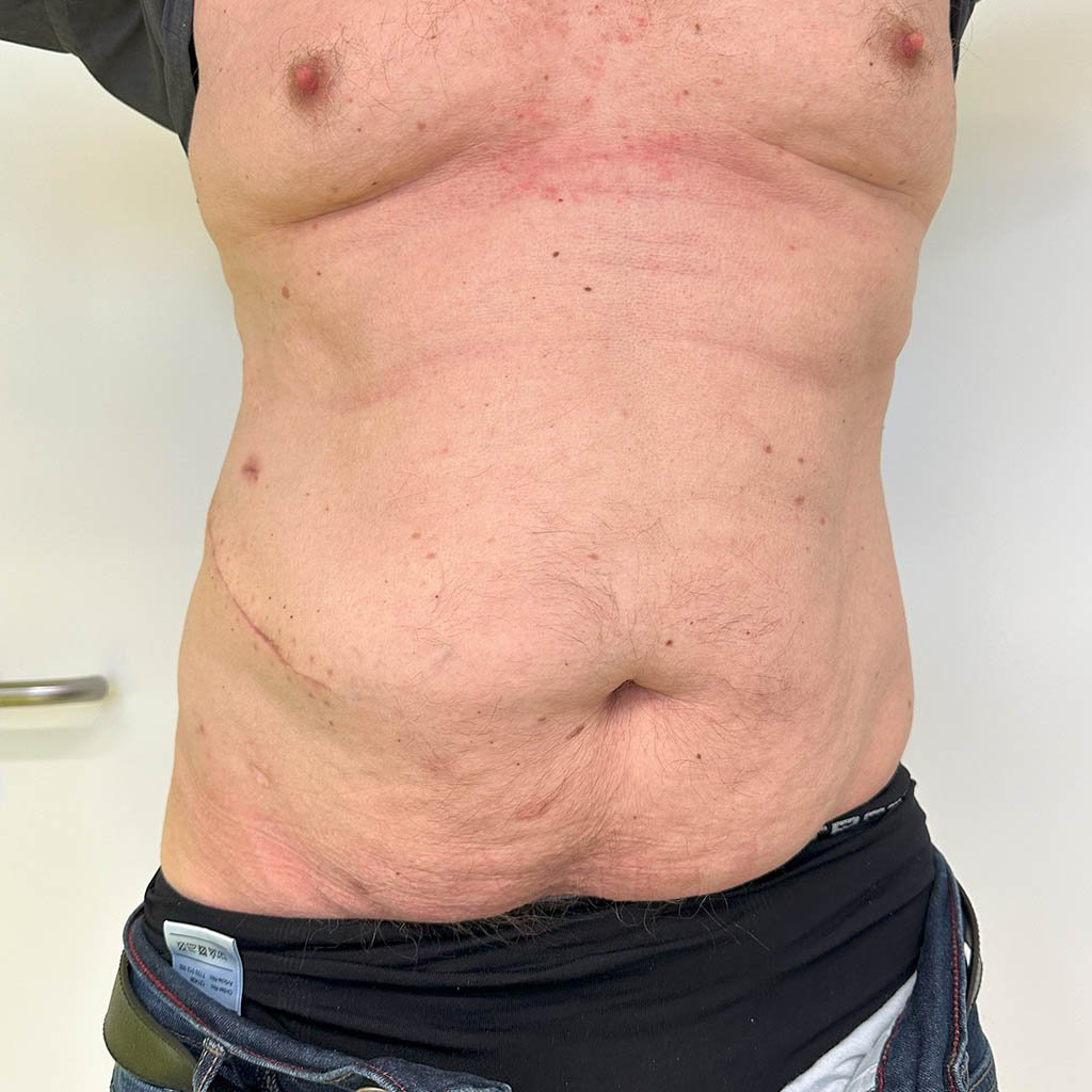 Lateral hernia__0015_Result_Post OP_1b