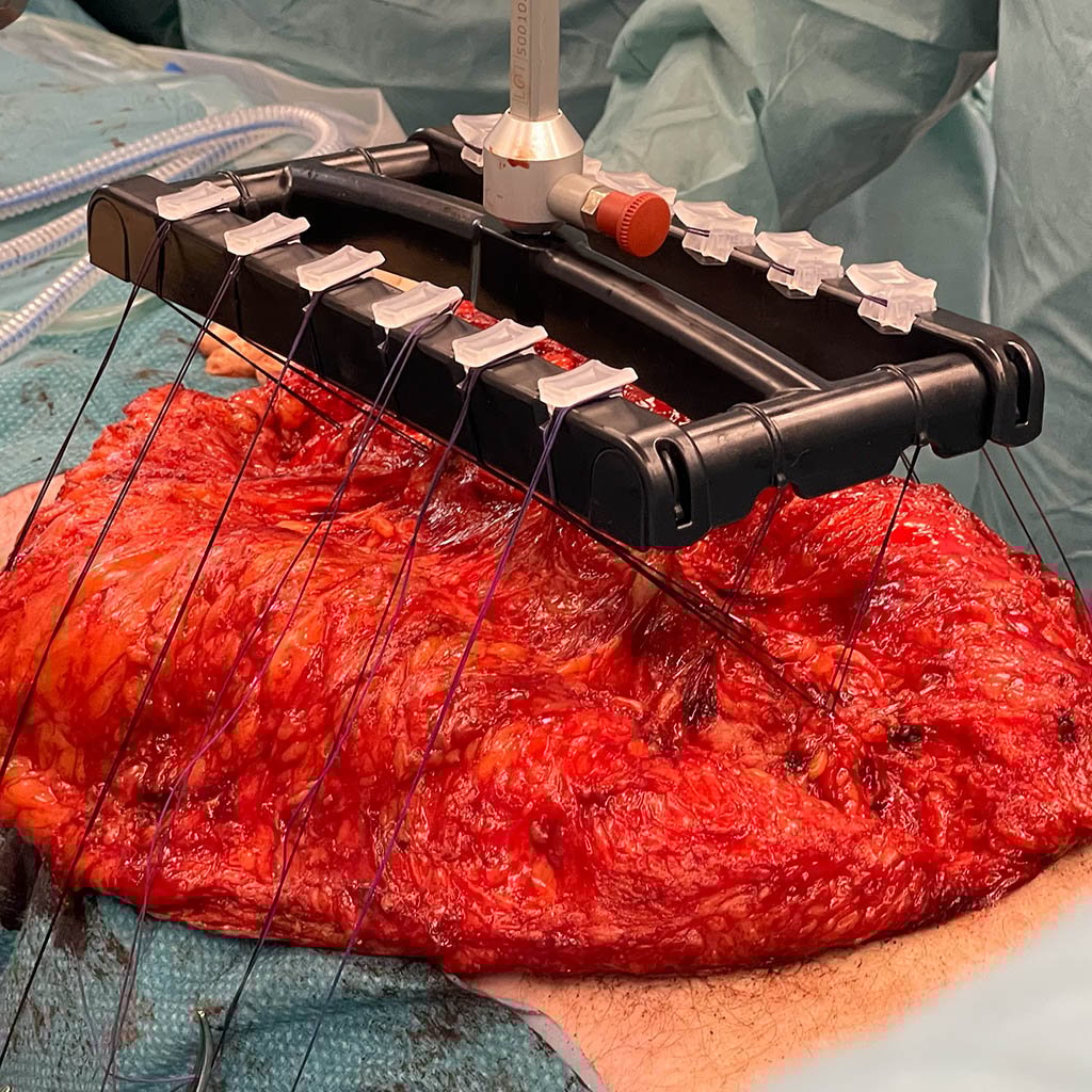 25 cm Giant Hernia_NL__0003_09_Full gain in fascia after only 15 min