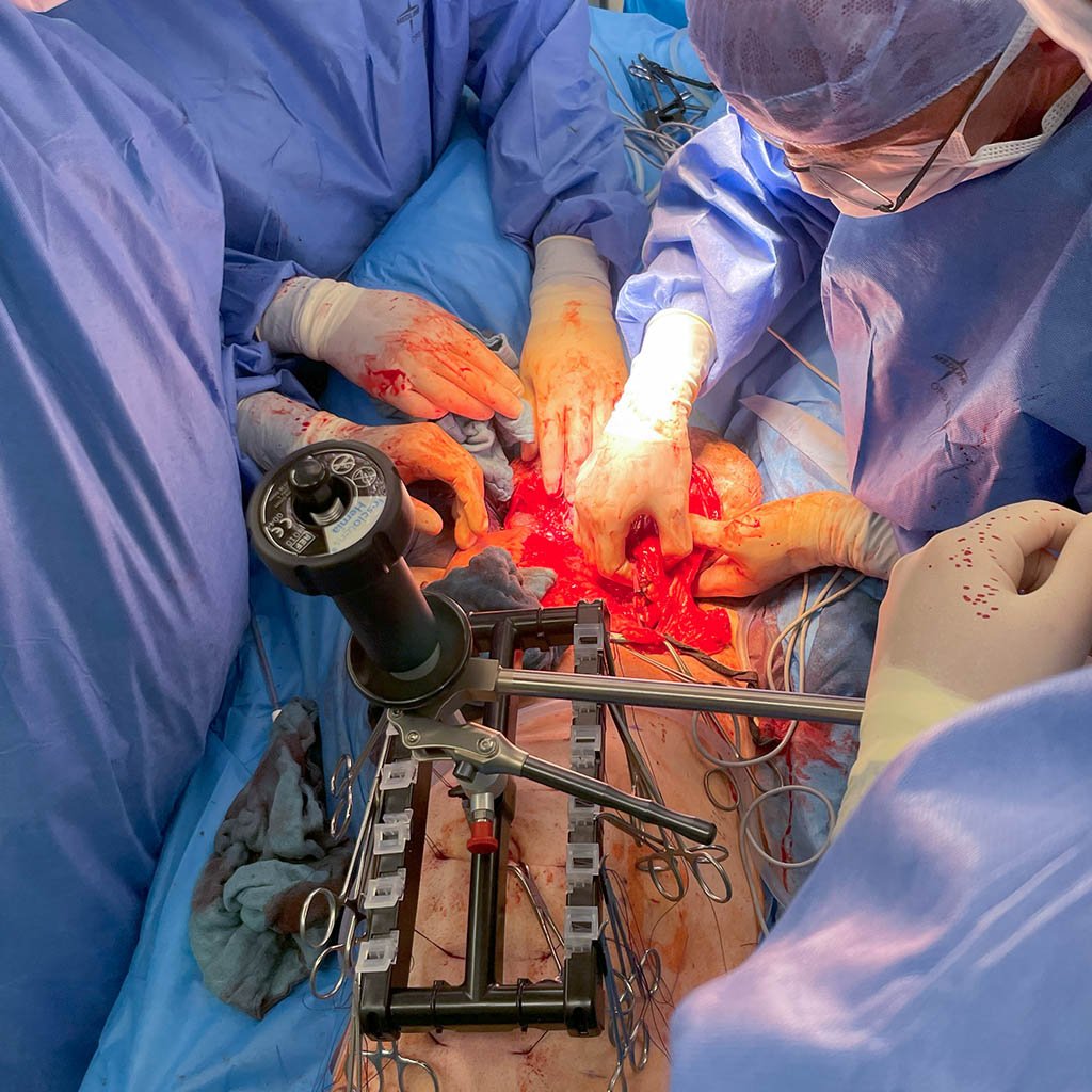 Giant scrotal hernia_Combination open_laparoscopic