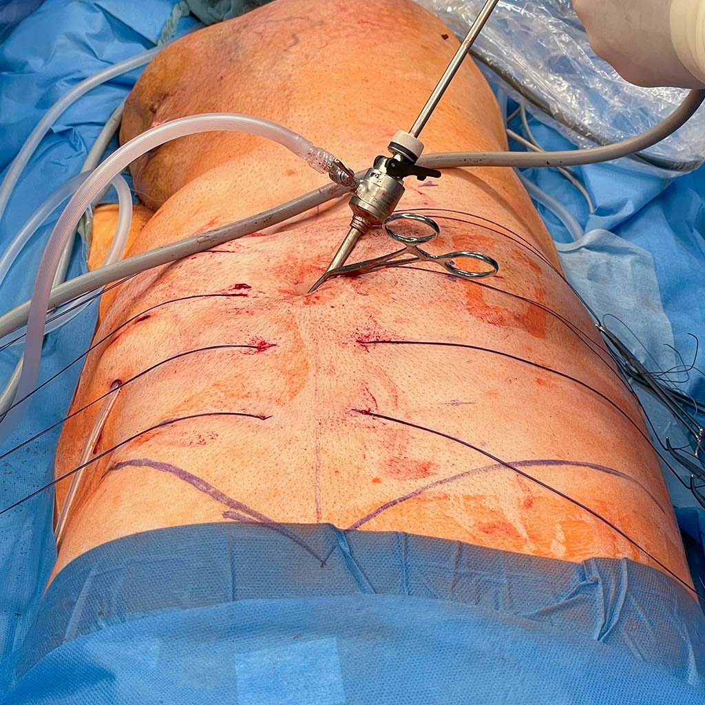 Giant scrotal hernia_Distribution Suture Threads