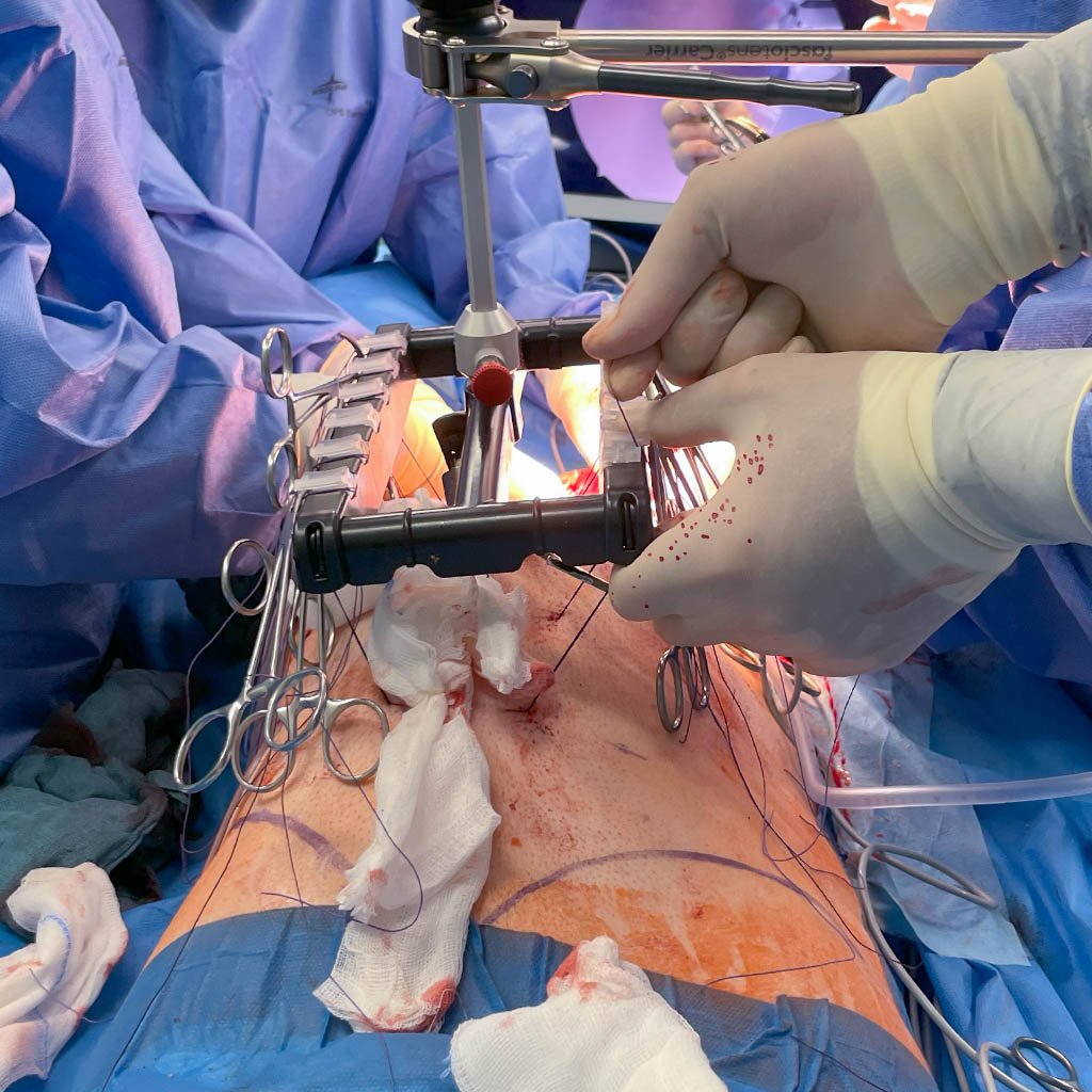 Giant scrotal hernia_Re-tightening the suture threads