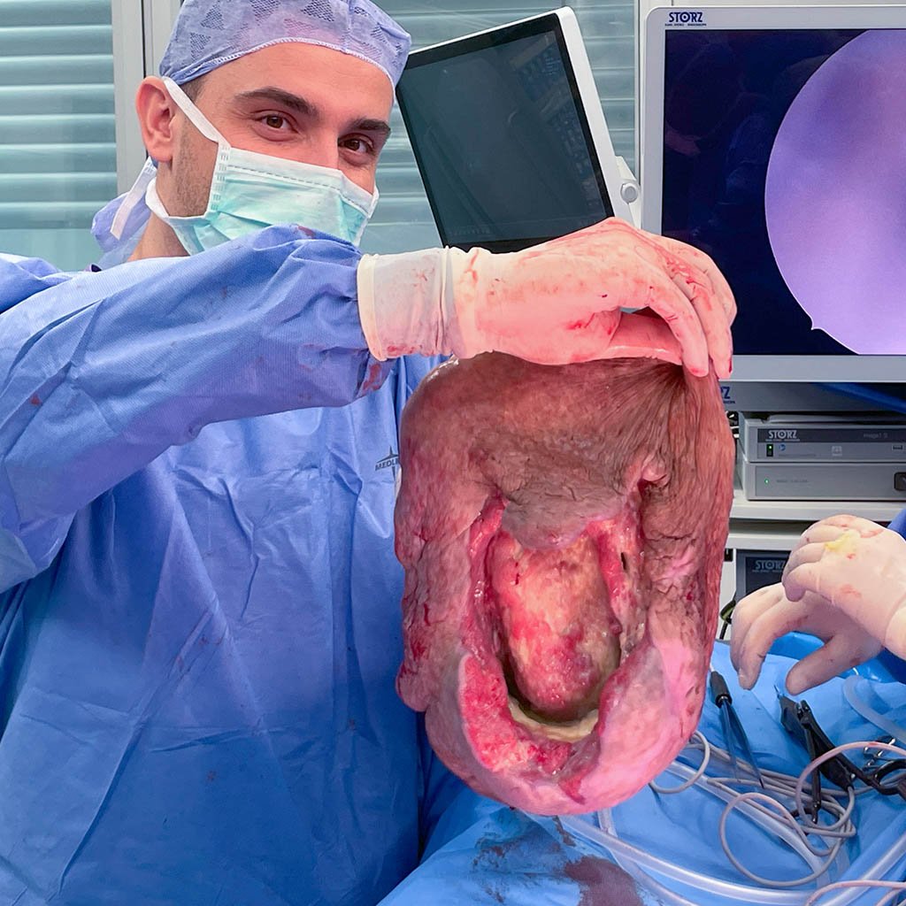 Giant scrotal hernia_Removal Skin