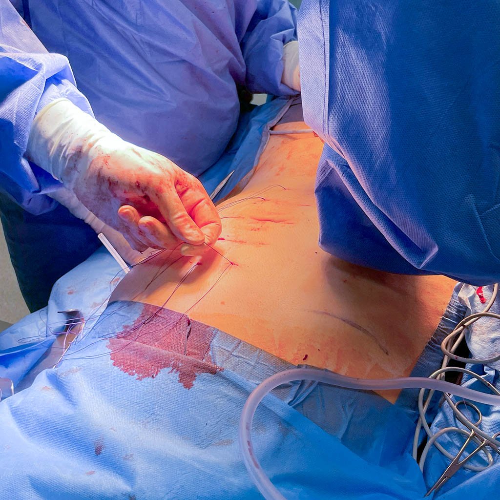 Giant scrotal hernia_Removing Suture Threds