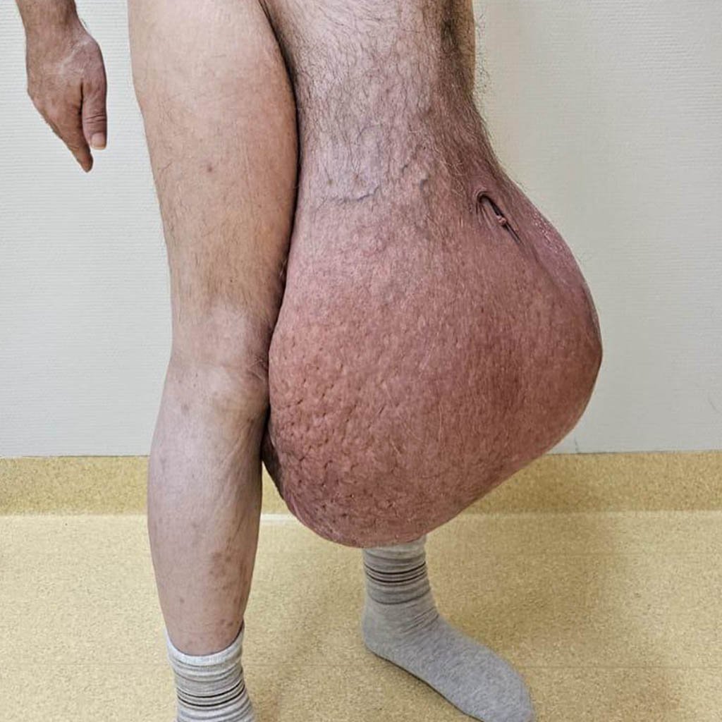 Giant scrotal hernia_before