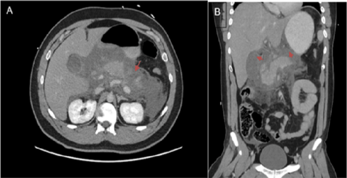 OA Severe Acute Pancreatitis_Tile