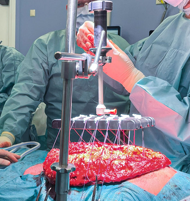 Hernia Application
