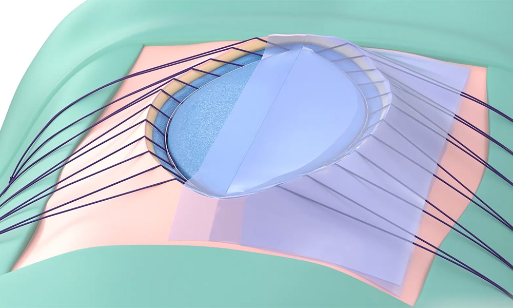 Abdomen-VAC_Video_1000x600