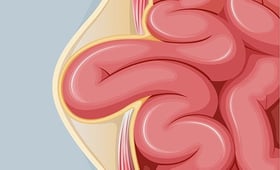 Quick Navigation_0002_Hernia_Tile_istockphoto-1400451533-1024x1024